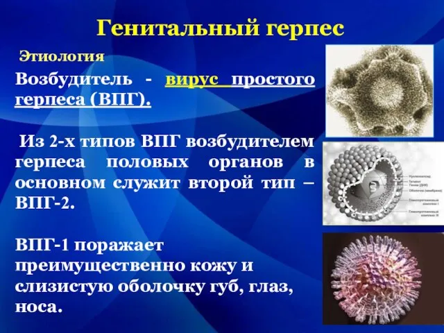 Генитальный герпес Возбудитель - вирус простого герпеса (ВПГ). Из 2-х типов