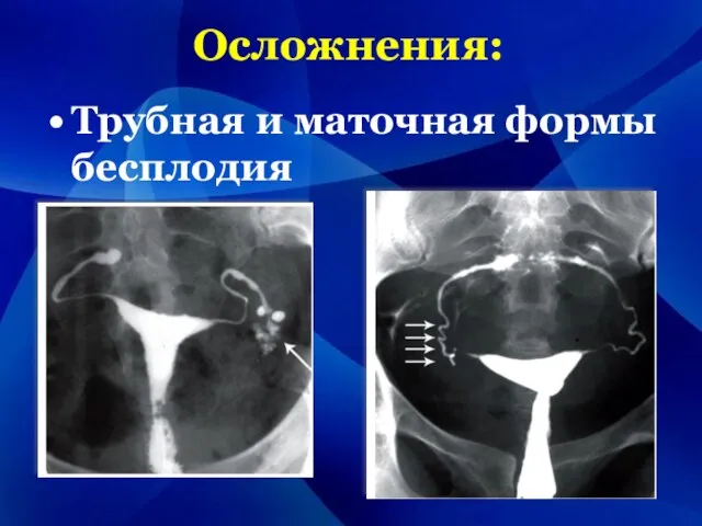 Осложнения: Трубная и маточная формы бесплодия