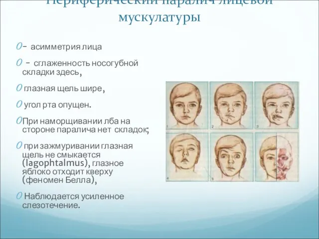 Периферический паралич лицевой мускулатуры - асимметрия лица - сглаженность носогубной складки