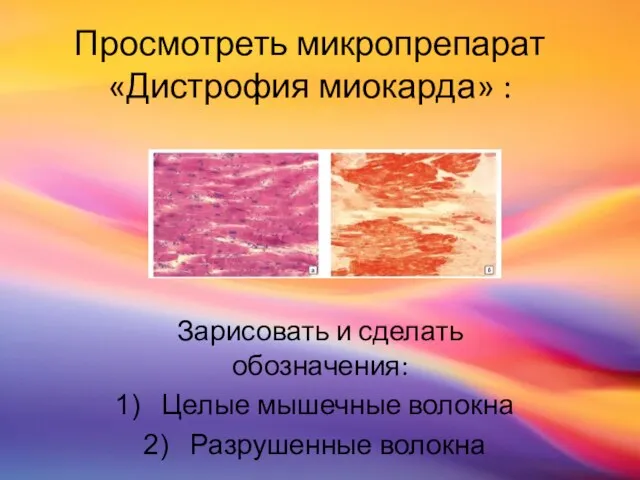 Просмотреть микропрепарат «Дистрофия миокарда» : Зарисовать и сделать обозначения: Целые мышечные волокна Разрушенные волокна