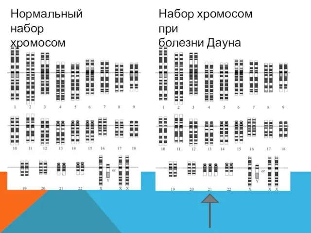 Нормальный набор хромосом Набор хромосом при болезни Дауна