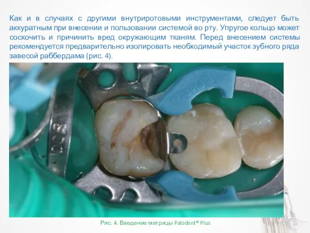 Рис. 4. Введение матрицы Palodent® Plus Как и в случаях с