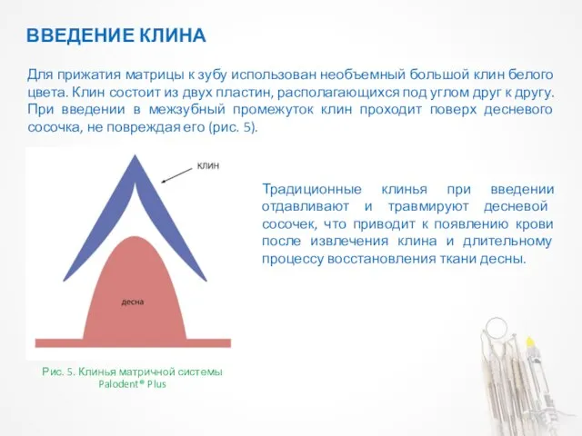 Для прижатия матрицы к зубу использован необъемный большой клин белого цвета.