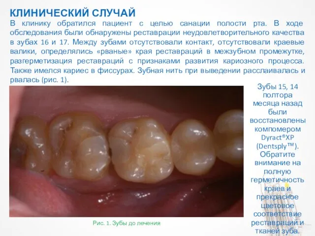 КЛИНИЧЕСКИЙ СЛУЧАЙ Рис. 1. Зубы до лечения В клинику обратился пациент
