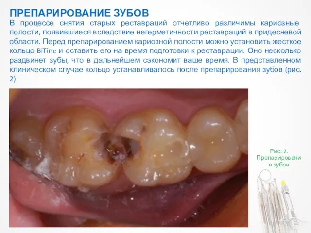 ПРЕПАРИРОВАНИЕ ЗУБОВ Рис. 2. Препарирование зубов В процессе снятия старых реставраций