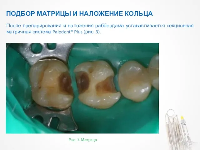 ПОДБОР МАТРИЦЫ И НАЛОЖЕНИЕ КОЛЬЦА Рис. 3. Матрица После препарирования и