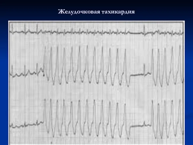 Желудочковая тахикардия