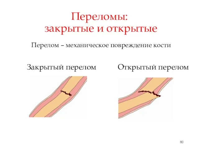 Переломы: закрытые и открытые Закрытый перелом Открытый перелом Перелом – механическое повреждение кости