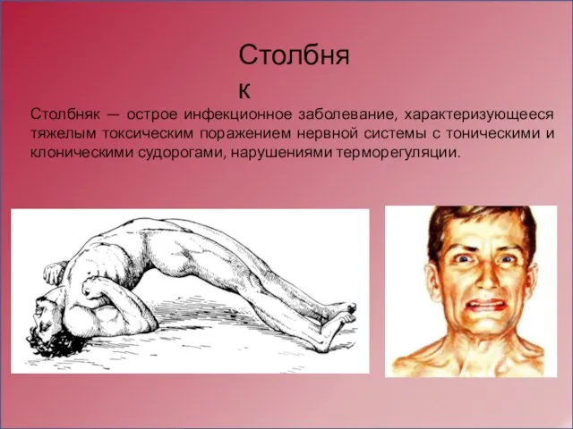 Столбняк — острое инфекционное заболевание, характеризующееся тяжелым токсическим поражением нервной системы