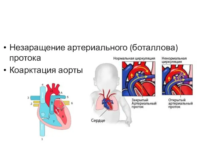 Незаращение артериального (боталлова) протока Коарктация аорты