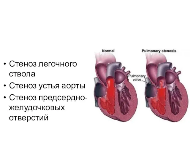 Стеноз легочного ствола Стеноз устья аорты Стеноз предсердно-желудочковых отверстий