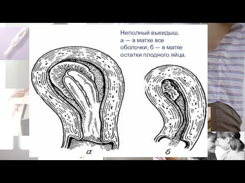 Неполный выкидыш. а — в матке все оболочки; б — в матке остатки плодного яйца.