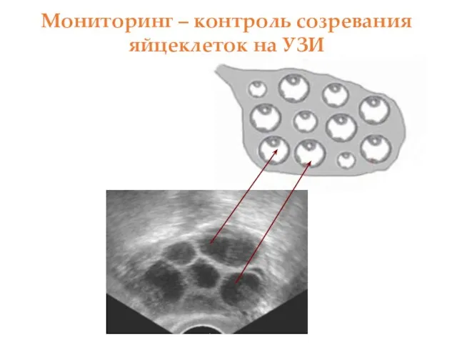 Мониторинг – контроль созревания яйцеклеток на УЗИ