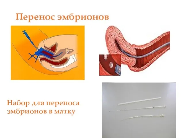 Перенос эмбрионов Набор для переноса эмбрионов в матку