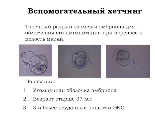 Вспомогательный хетчинг Точечный разрыв оболочки эмбриона для облегчения его имплантации при