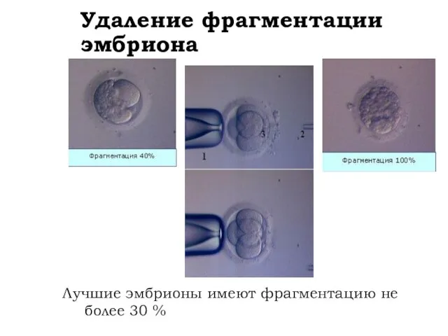 Удаление фрагментации эмбриона Лучшие эмбрионы имеют фрагментацию не более 30 %