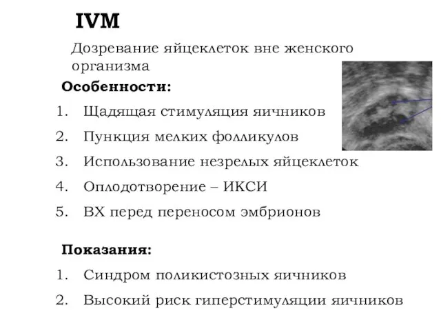 IVM Дозревание яйцеклеток вне женского организма Показания: Синдром поликистозных яичников Высокий