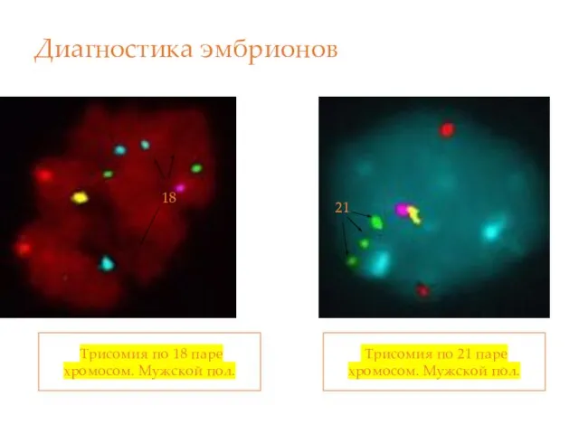 Диагностика эмбрионов Трисомия по 21 паре хромосом. Мужской пол. Трисомия по