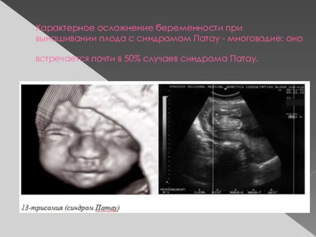 Характерное осложнение беременности при вынашивании плода с синдромом Патау - многоводие: