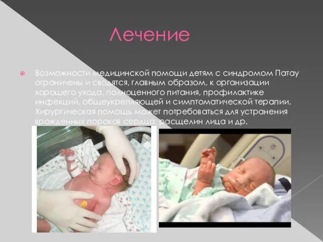 Лечение Возможности медицинской помощи детям с синдромом Патау ограничены и сводятся,