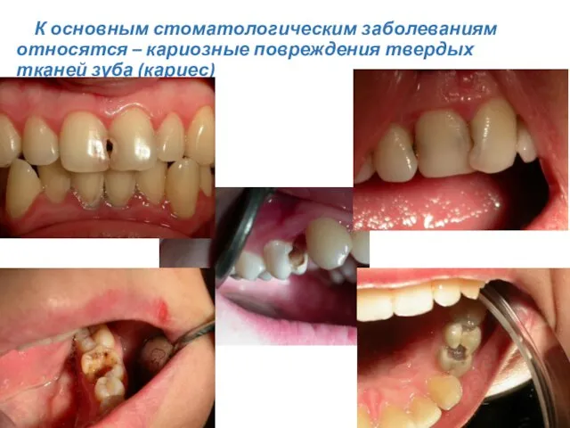 К основным стоматологическим заболеваниям относятся – кариозные повреждения твердых тканей зуба (кариес)