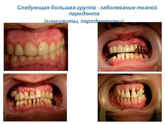 Следующая большая группа - заболевания тканей пародонта (гингивиты, пародонтиты).