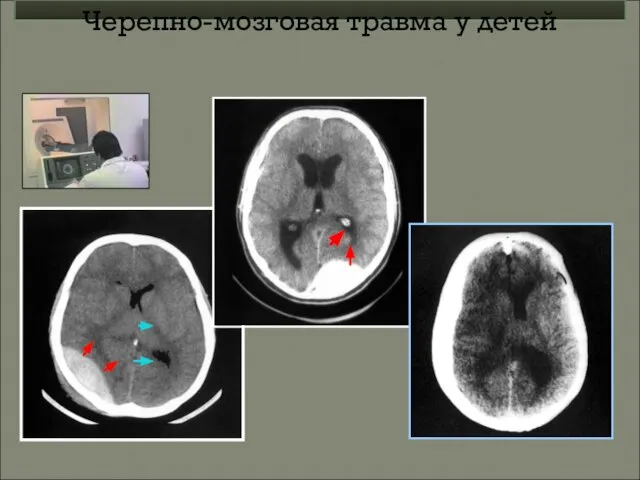 Черепно-мозговая травма у детей