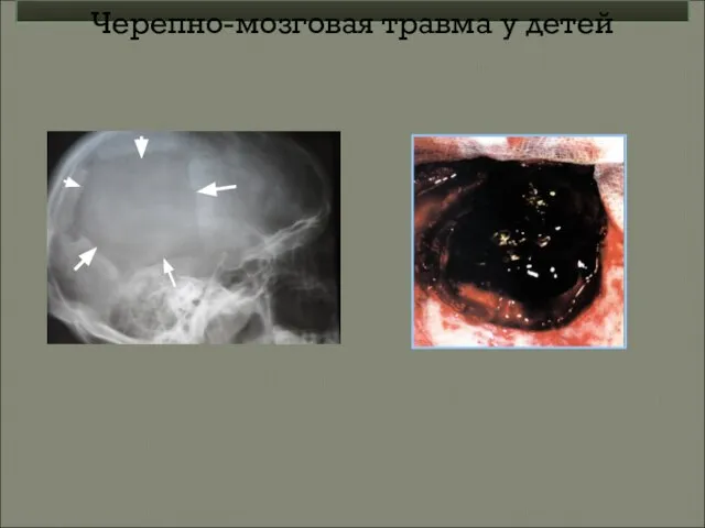 Черепно-мозговая травма у детей