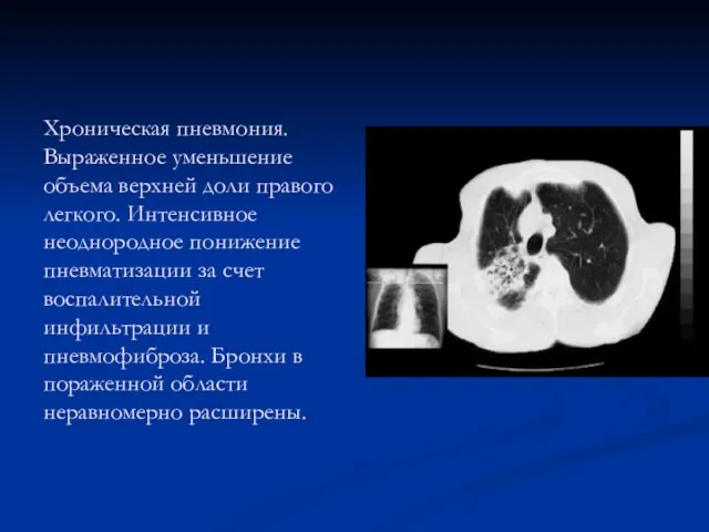 Хроническая пневмония. Выраженное уменьшение объема верхней доли правого легкого. Интенсивное неоднородное