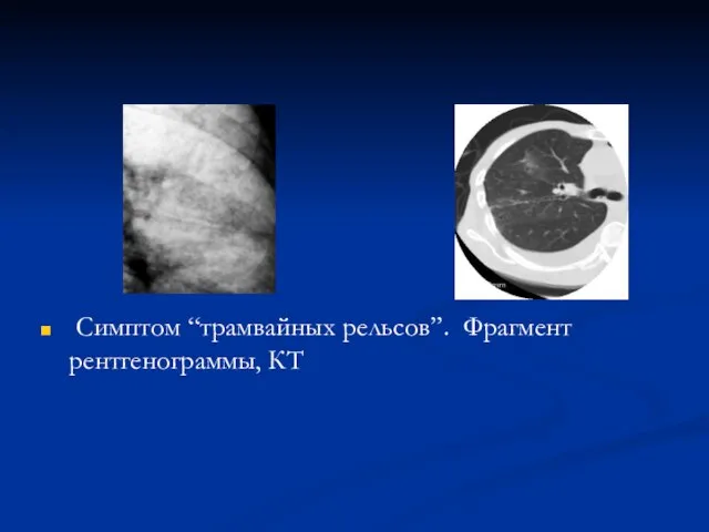 Симптом “трамвайных рельсов”. Фрагмент рентгенограммы, КТ