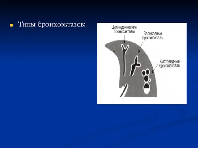 Типы бронхоэктазов: