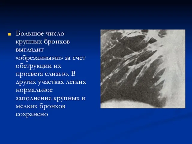 Большое число крупных бронхов выглядит «обрезанными» за счет обструкции их просвета