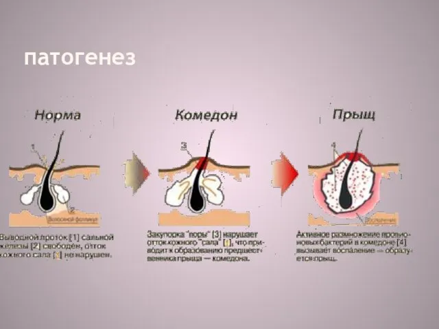 патогенез