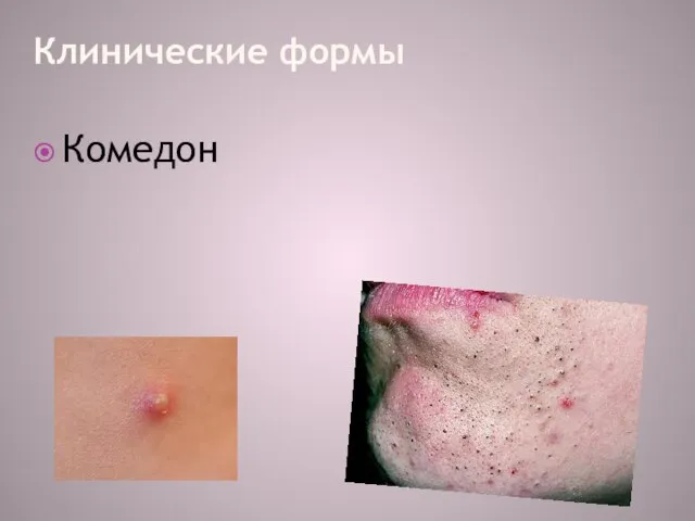 Клинические формы Комедон