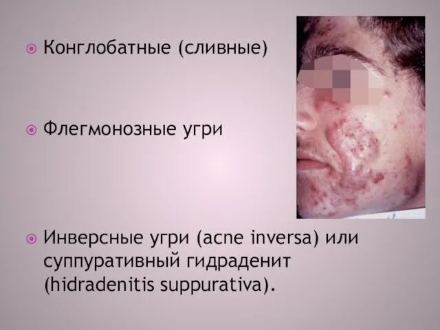 Конглобатные (сливные) Флегмонозные угри Инверсные угри (acne inversa) или суппуративный гидраденит (hidradenitis suppurativa).