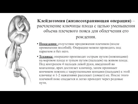 Клейдотомия (жизнесохраняющая операция) – расчленение ключицы плода с целью уменьшения объема