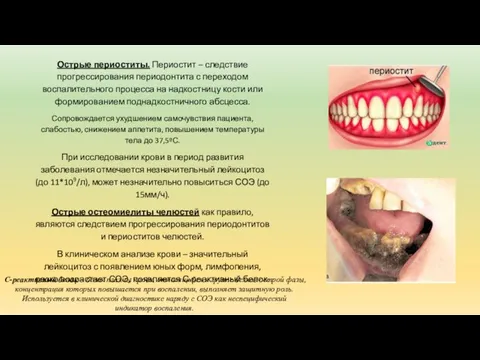 Острые периоститы. Периостит – следствие прогрессирования периодонтита с переходом воспалительного процесса