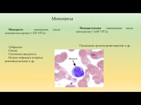 Моноцитопения –уменьшение числа моноцитов ( Гипоплазия органов кроветворения и др. Моноциты