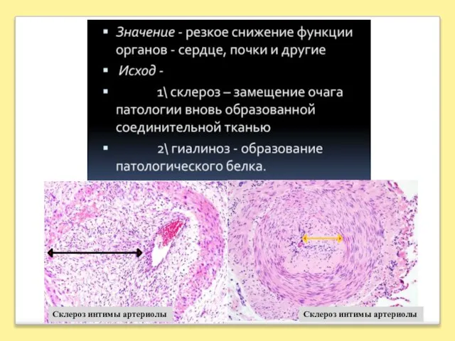 Склероз интимы артериолы Склероз интимы артериолы