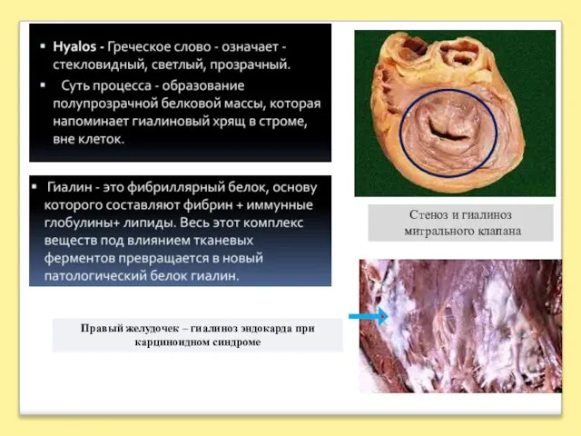 Стеноз и гиалиноз митрального клапана Правый желудочек – гиалиноз эндокарда при карциноидном синдроме