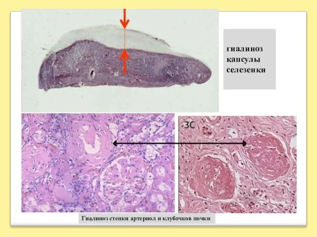 гиалиноз капсулы селезенки Гиалиноз стенки артериол и клубочков почки