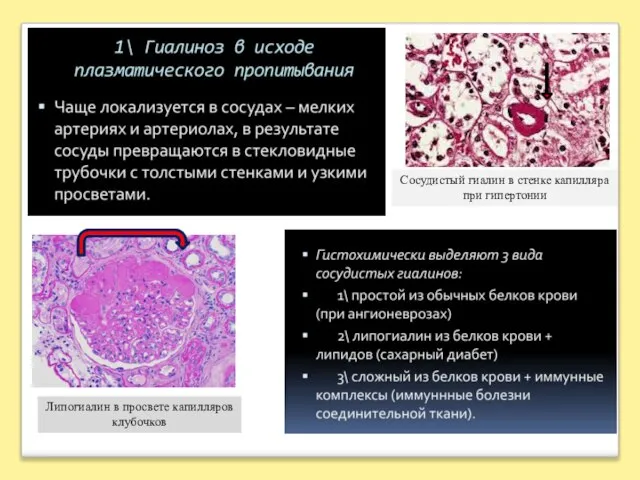 Липогиалин в просвете капилляров клубочков Сосудистый гиалин в стенке капилляра при гипертонии