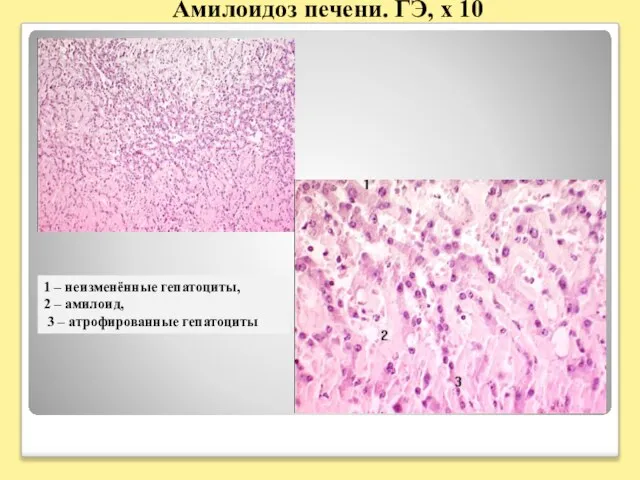 Амилоидоз печени. ГЭ, х 10 1 – неизменённые гепатоциты, 2 – амилоид, 3 – атрофированные гепатоциты