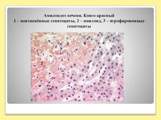 Амилоидоз печени. Конго красный 1 – неизменённые гепатоциты, 2 – амилоид, 3 – атрофированные гепатоциты