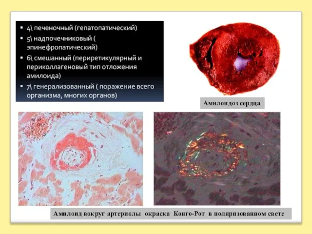 Амилоидоз сердца Амилоид вокруг артериолы окраска Конго-Рот в поляризованном свете