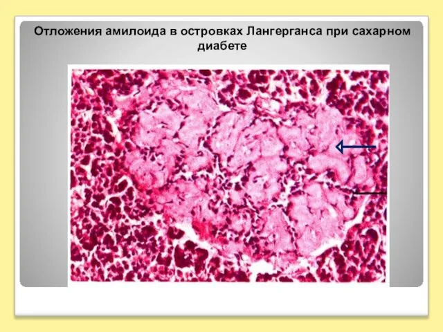 Отложения амилоида в островках Лангерганса при сахарном диабете