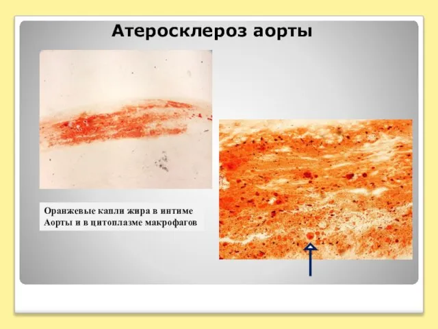 Атеросклероз аорты Оранжевые капли жира в интиме Аорты и в цитоплазме макрофагов