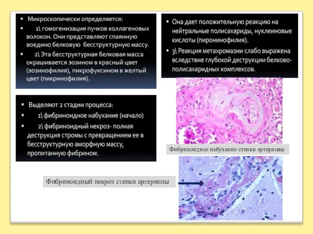 Фибриноидное набухание стенки артериолы Фибриноидный некроз стенки артериолы