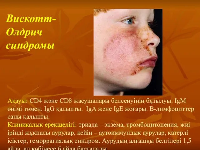 Ақауы: CD4 және CD8 жасушалары белсенуінің бұзылуы. IgM өнімі төмен. IgG