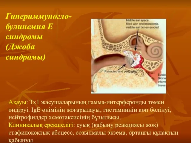 Ақауы: Тх1 жасушаларының гамма-интерферонды төмен өндіруі. IgE өнімінің жоғарылауы, гистаминнің көп